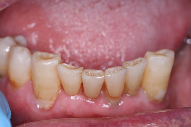 Incisal Bonding Before